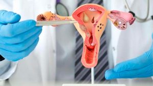 Brasil pode ultrapassar marca histórica de mortes por câncer de colo de útero em 2025