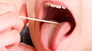 Atendimento por infecções de garganta crescem no estado